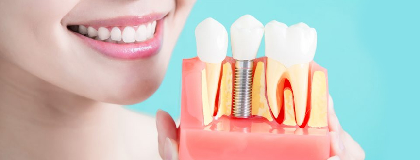 Dental implants1