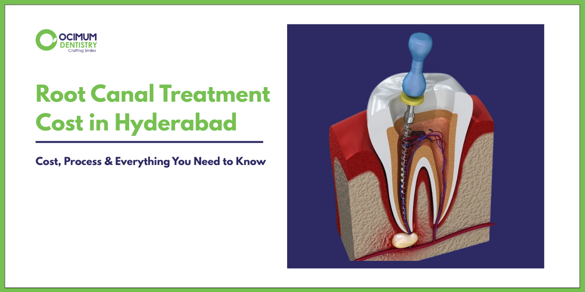 Root Canal Treatment Cost in Hyderabad | Ocimum Dentistry, Jubilee Hills