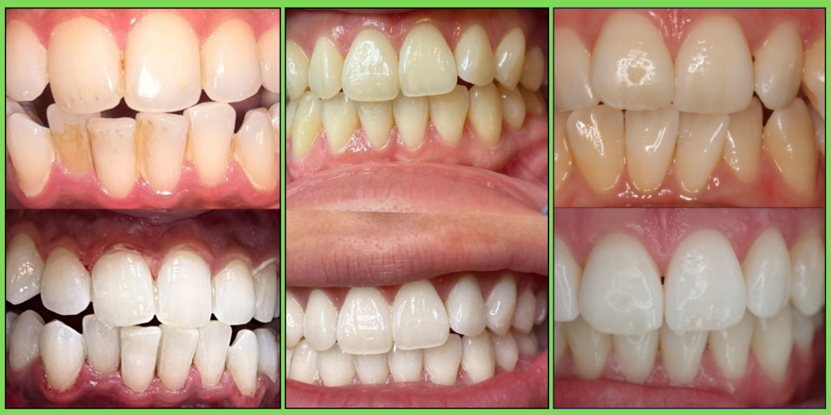 Before & After Teeth Whitening Results in Jubilee Hills, Hyderabad